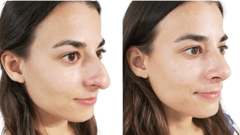 rhinoplasty before and after case 14