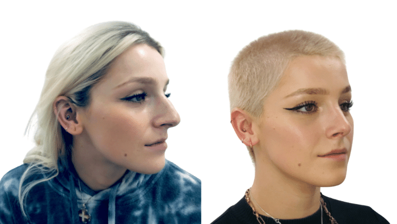 rhinoplasty before and after case 1 three-quarter view