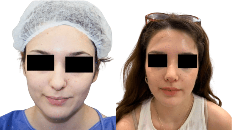 corrective rhinoplasty before and after case 11