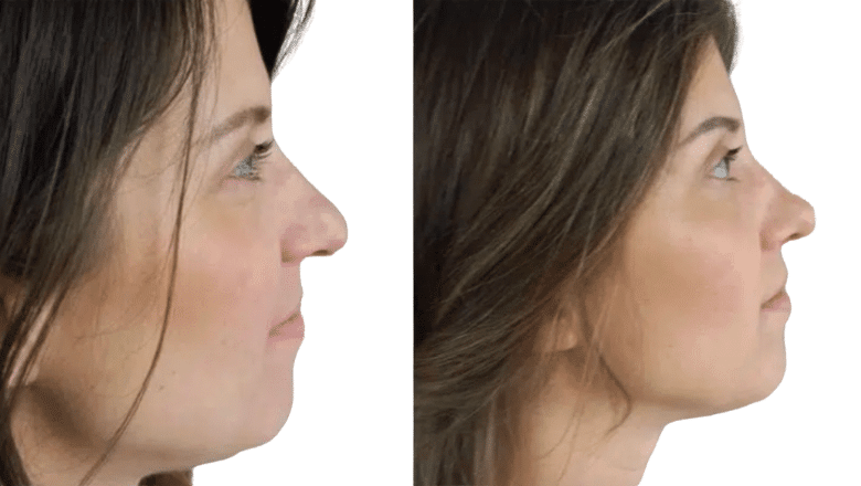 rhinoplasty before and after case 13