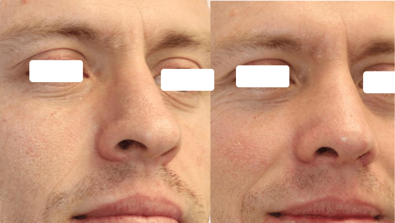male ethnic rhinoplasty before and after case M7