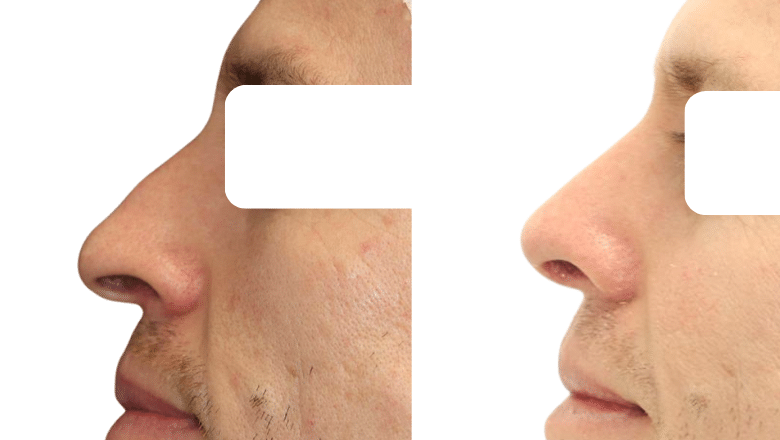 male ethnic rhinoplasty before and after case M8