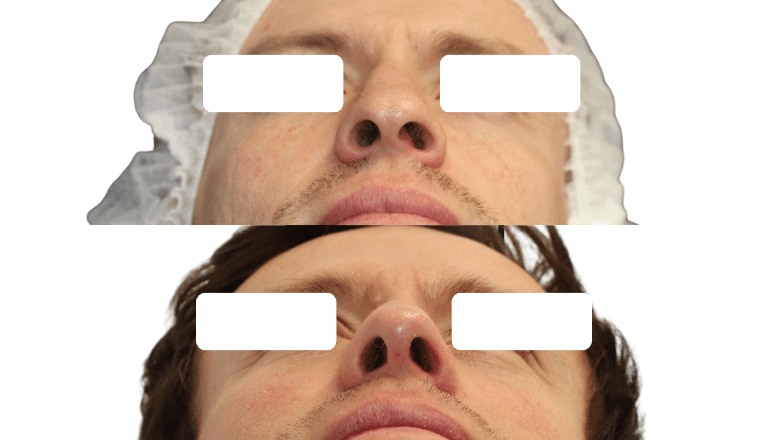 male ethnic rhinoplasty before and after case M9