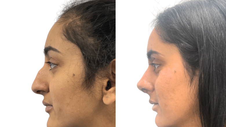 female rhinoplasty London before and after case 22