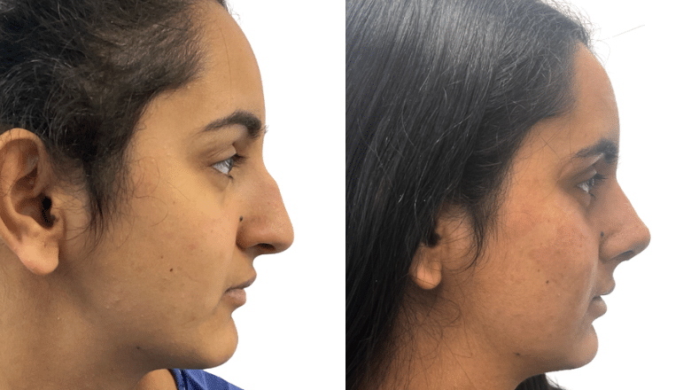 female rhinoplasty UK before and after case 23
