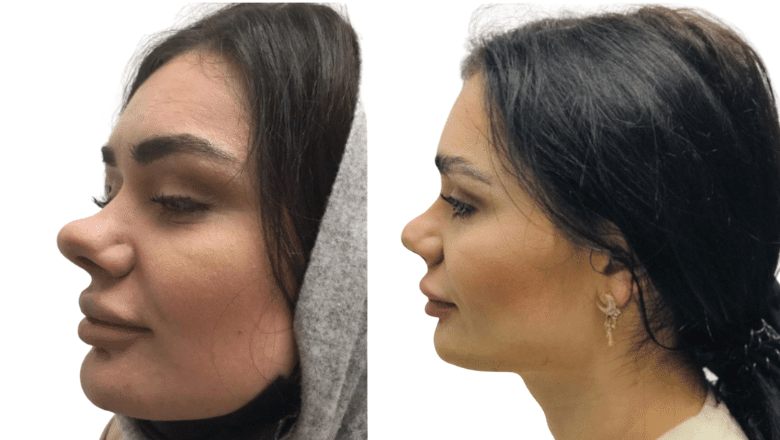 functional and cosmetic rhinoplasty results case 7