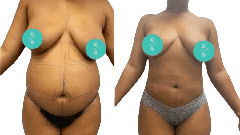 Liposuction Harley Street
