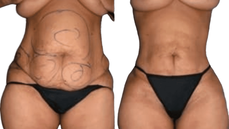 Liposuction London