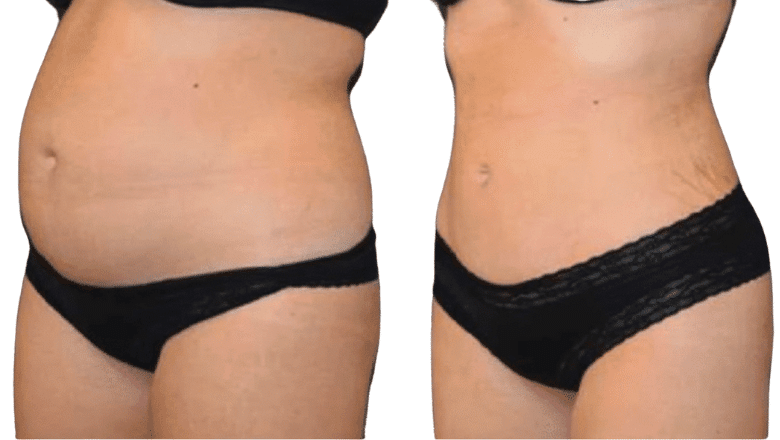 Liposuction specialist London