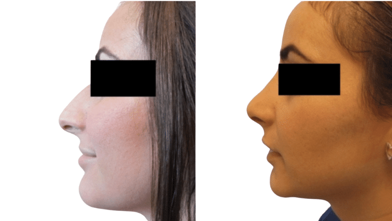 rhinoplasty before and after case 18