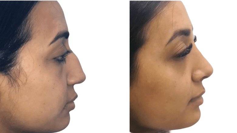 rhinoplasty before and after case 3