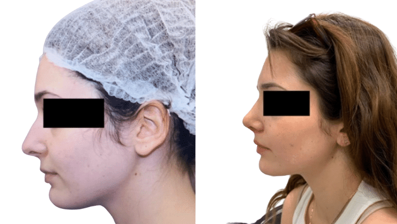corrective rhinoplasty before and after case 11 side view