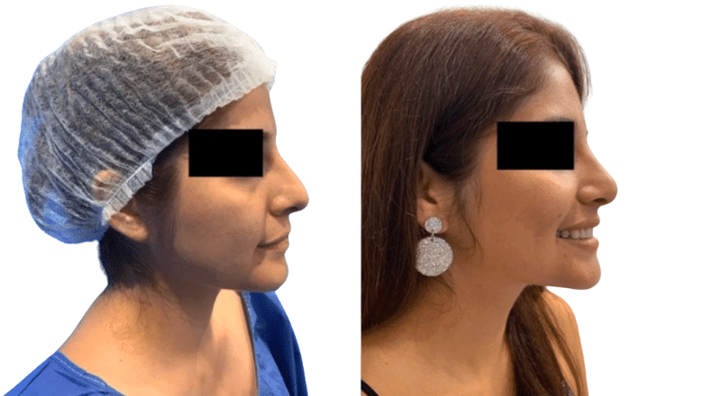 rhinoplasty before and after case 9 side view
