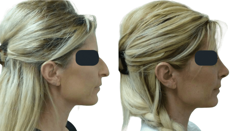 rhinoplasty before and after case 16