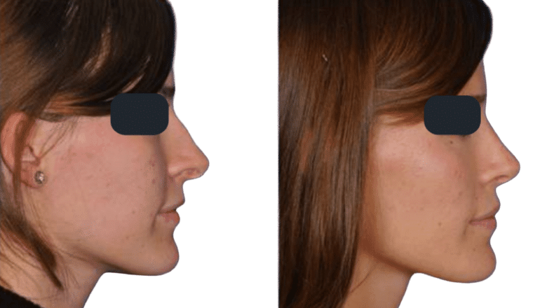rhinoplasty hump removal before and after case 10 side view