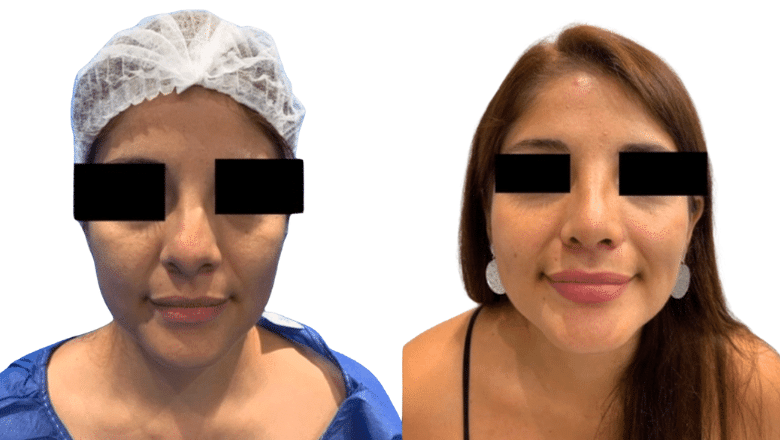 rhinoplasty before and after case 9 front view