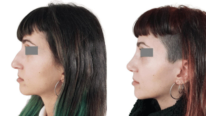 rhinoplasty before and after case 19