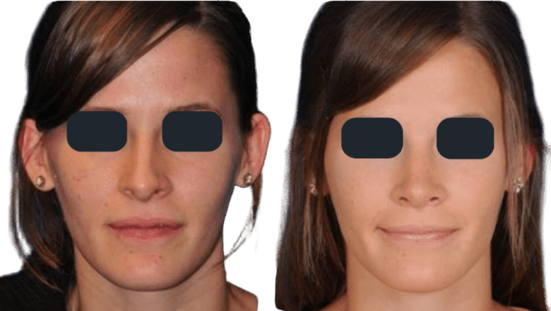 rhinoplasty hump removal before and after case 10