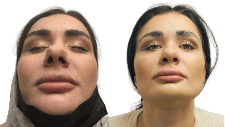 rhinoplasty before and after case 7 view 4