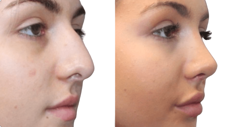 revision rhinoplasty before and after case 2 side view