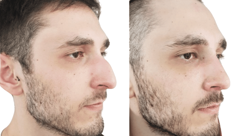 male rhinoplasty before and after case M2
