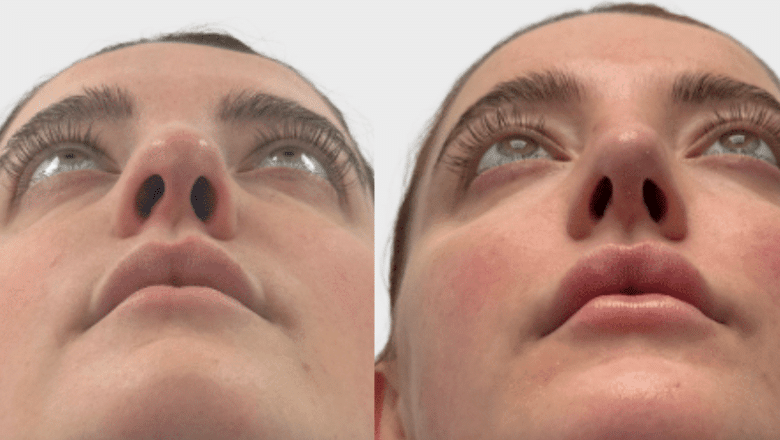 rhinoplasty before and after case 21