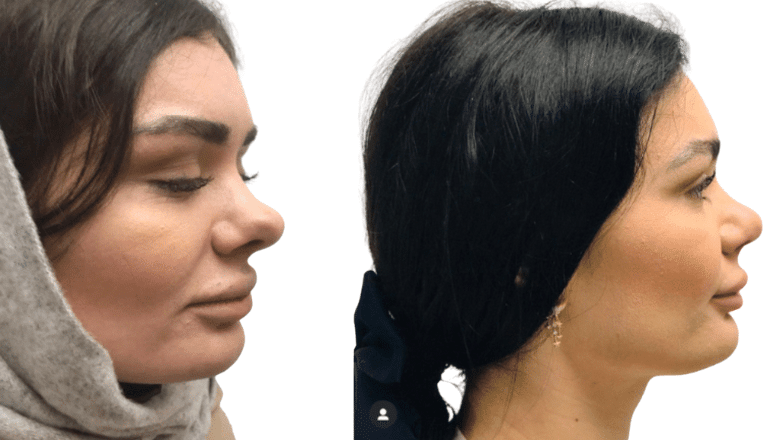 rhinoplasty before and after case 7 view 2