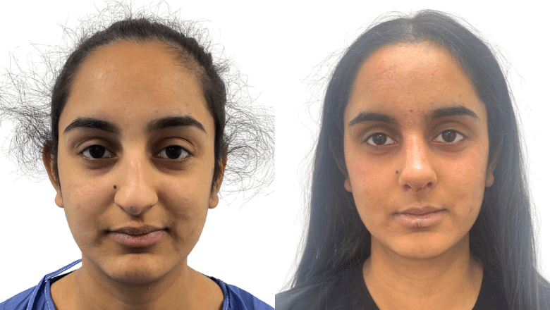 rhinoplasty London UK before and after case 24