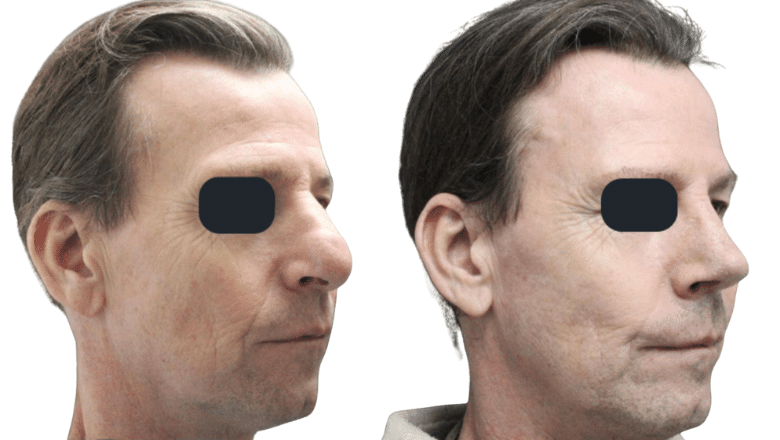 revision rhinoplasty before and after case R2
