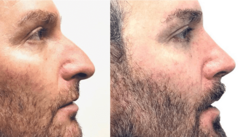male rhinoplasty side view before and after case M5