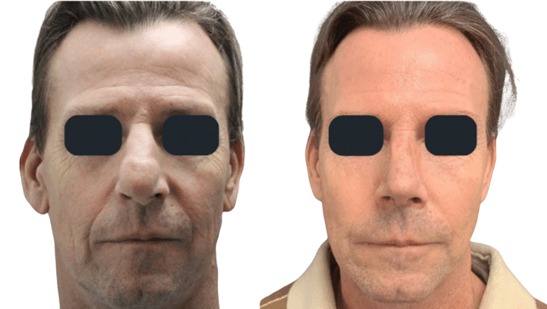 revision rhinoplasty before and after case R3