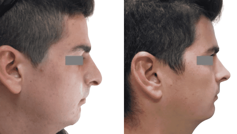 male rhinoplasty side profile before and after case M4