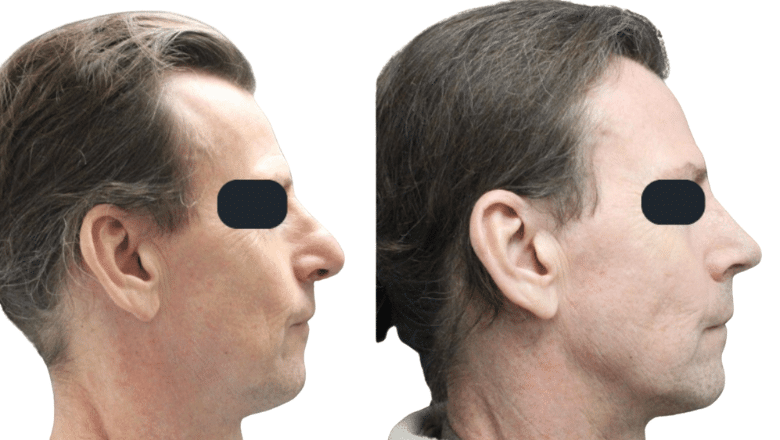 revision rhinoplasty before and after case R1