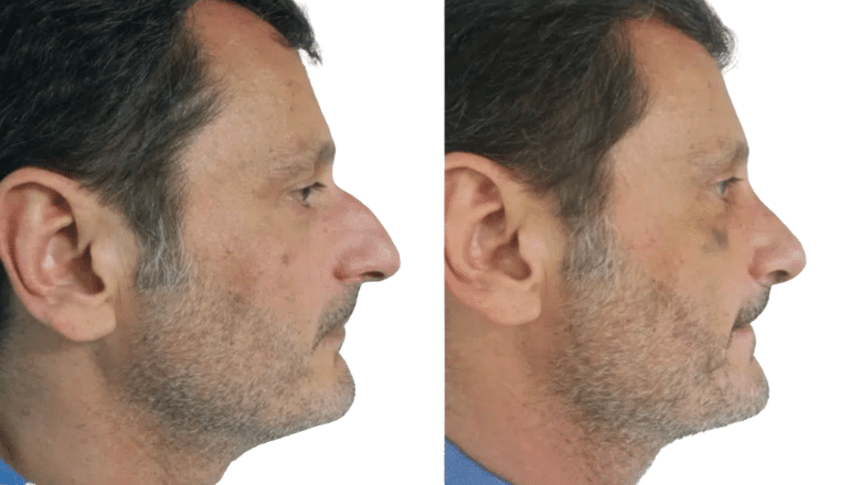 male rhinoplasty UK before and after case M6