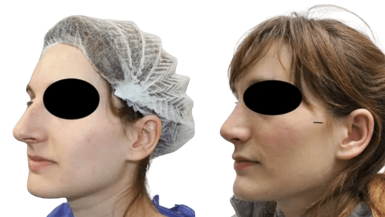 rhinoplasty before and after case 15