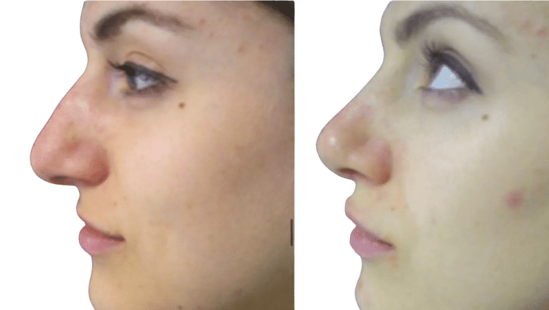 rhinoplasty before and after case 12 side view