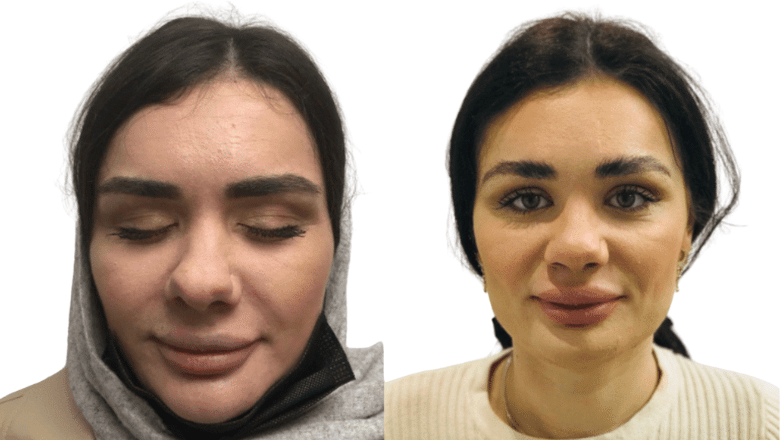 rhinoplasty before and after case 7 view 3