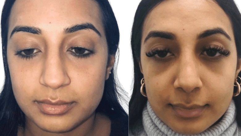 rhinoplasty before and after case 3 side view