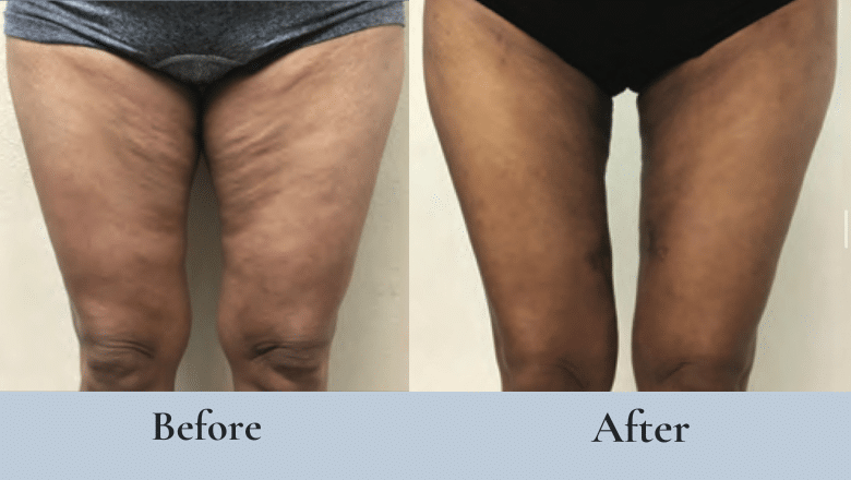 thigh lift before and after case 4