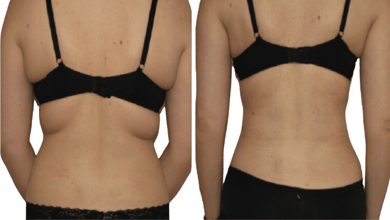 Vaser liposuction Harley Street – real transformations
