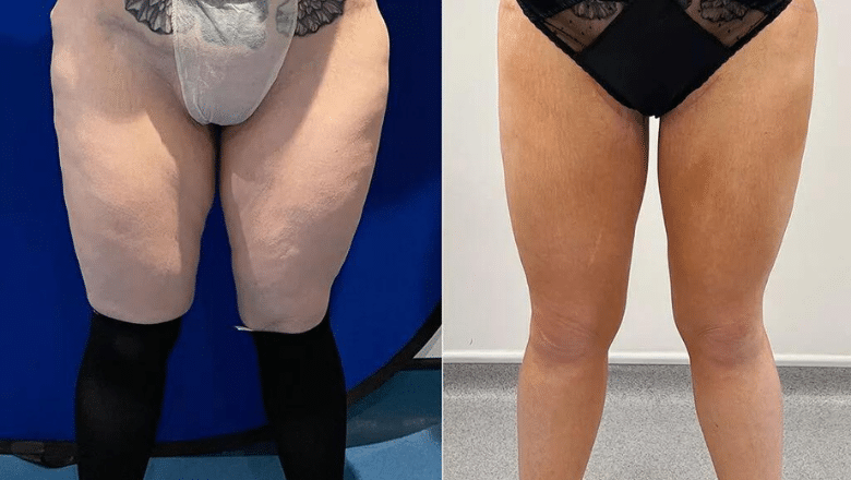 inner thigh lift surgery before and after case 5