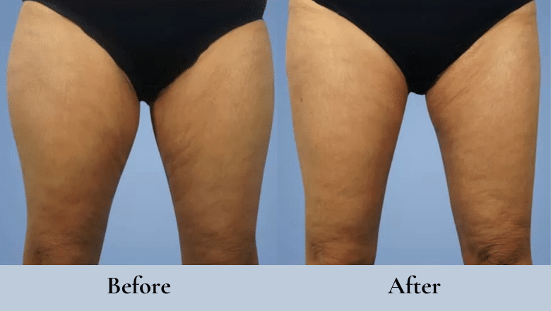 thigh lift before and after case 6
