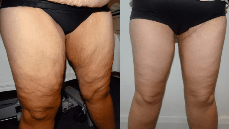 thigh lift before and after photos case 3