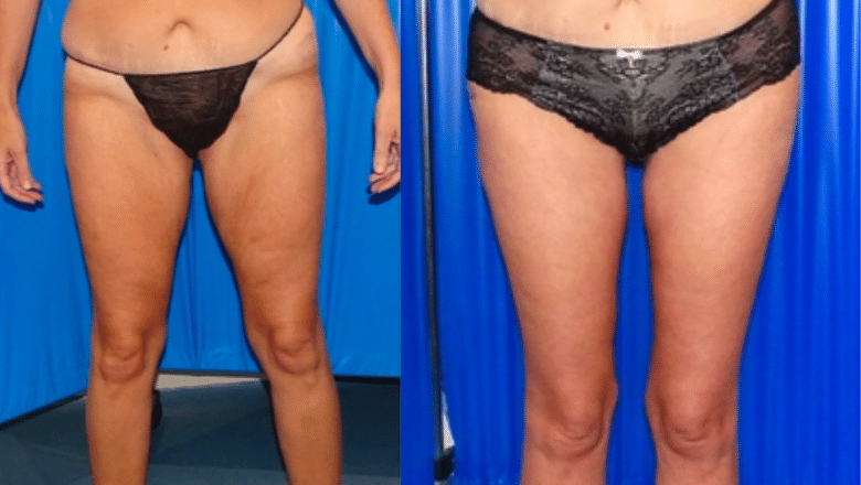 thigh lift before and after photos case 1