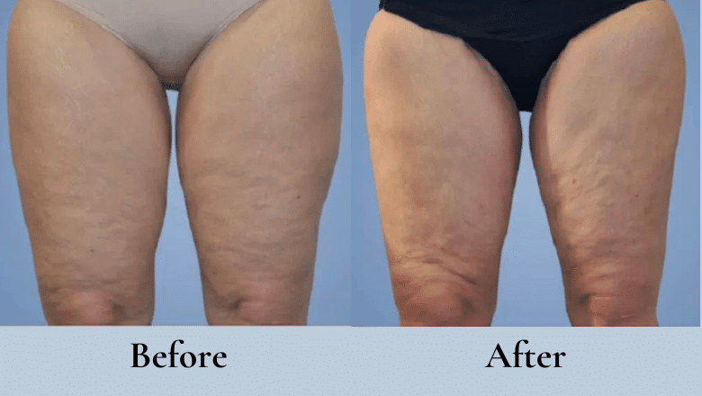 thigh lift surgery before and after case 2