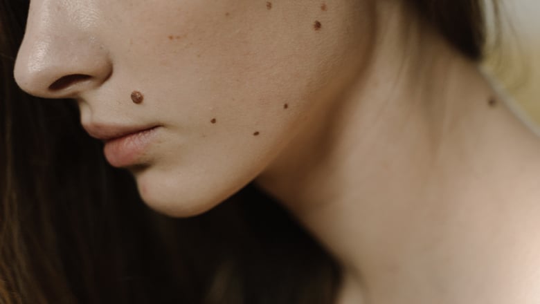 Itchy or bleeding mole assessment at Centre for Surgery London