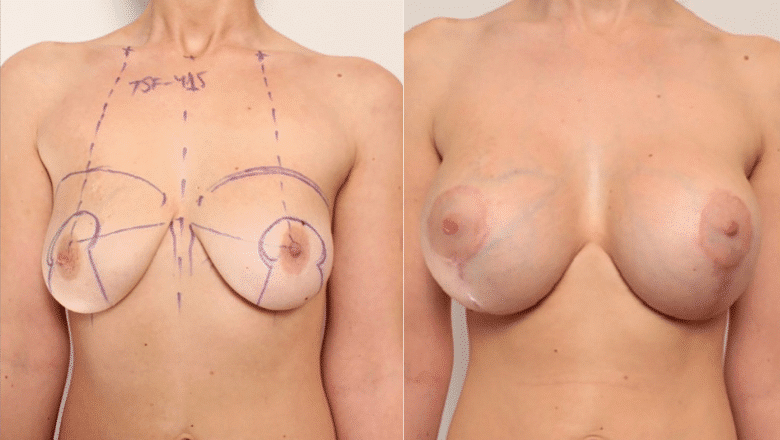 breast lift and implants
