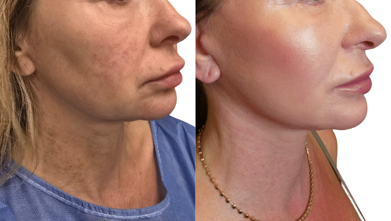 Facelift Result