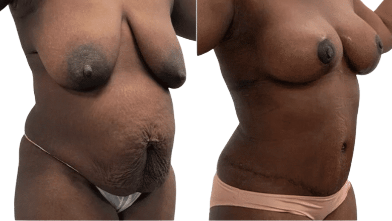 abdominoplasty mummy makeover case 2 view 3