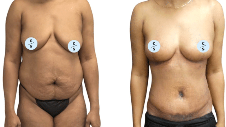 mummy makeover before and after case 1